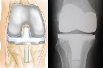 Total Knee Replacement - Day 9 photo