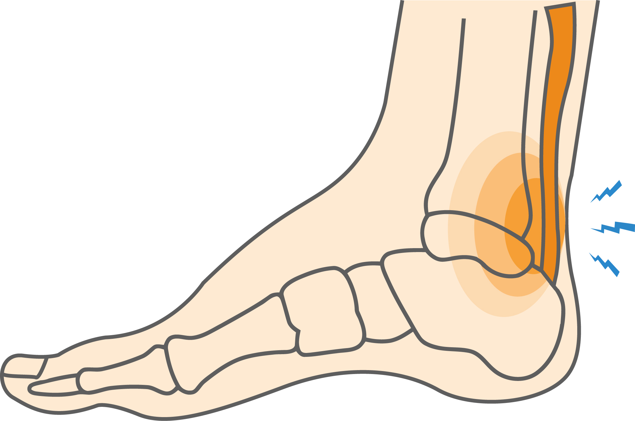 Achilles Debridement  photo